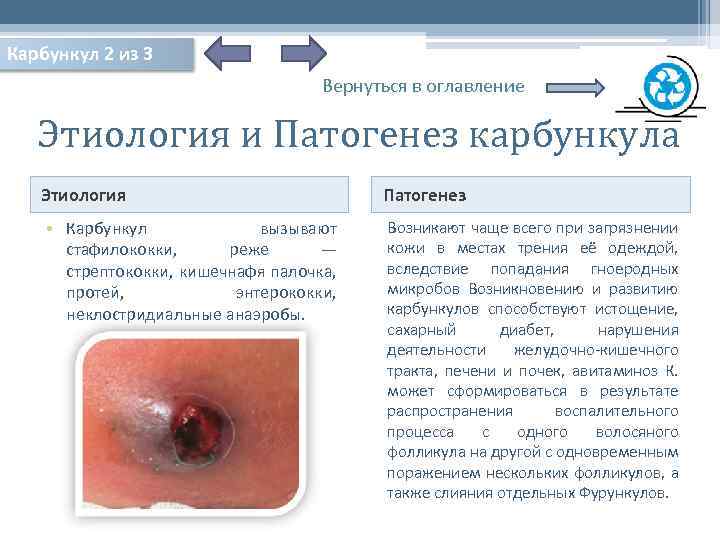Карбункул 2 из 3 Вернуться в оглавление Этиология и Патогенез карбункула Этиология Патогенез •