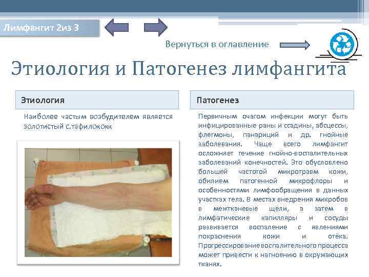 Лимфангит 2 из 3 Вернуться в оглавление Этиология и Патогенез лимфангита Этиология Наиболее частым