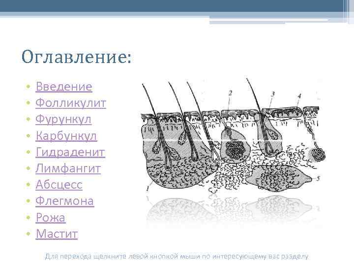Оглавление: • • • Введение Фолликулит Фурункул Карбункул Гидраденит Лимфангит Абсцесс Флегмона Рожа Мастит