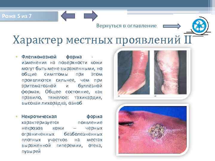 Рожа 5 из 7 Вернуться в оглавление Характер местных проявлений II • Флегмонозной форма