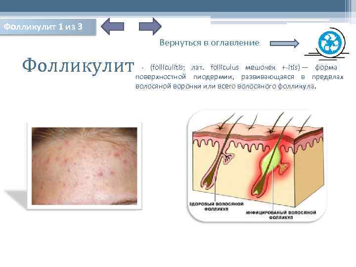 Фолликулит 1 из 3 Вернуться в оглавление Фолликулит - (folliculitis; лат. folliculus мешочек +-itis)