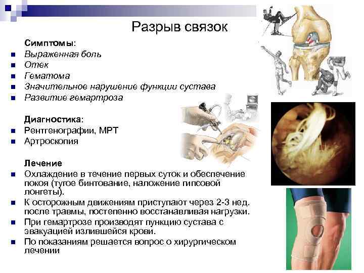 Разрыв связок n n n Симптомы: Выраженная боль Отек Гематома Значительное нарушение функции сустава