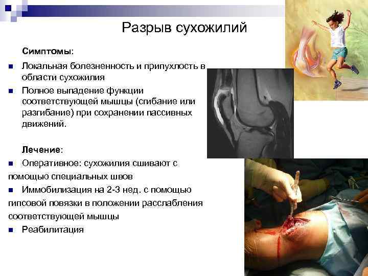Разрыв сухожилий Симптомы: n n Локальная болезненность и припухлость в области сухожилия Полное выпадение