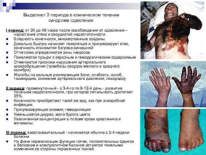 Выделяют 3 периода в клиническом течении синдрома сдавления: I период: от 24 до 48