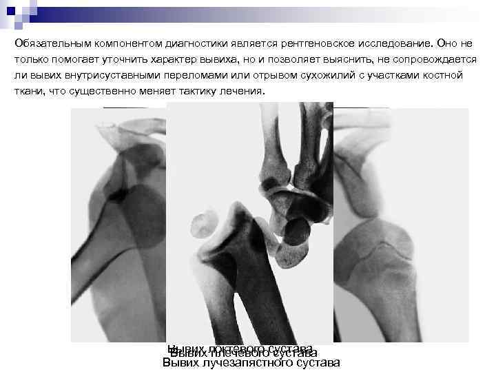 Обязательным компонентом диагностики является рентгеновское исследование. Оно не только помогает уточнить характер вывиха, но