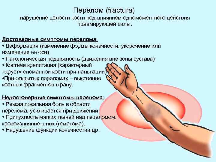 Перелом (fractura) нарушение целости кости под влиянием одномоментного действия травмирующей силы. Достоверные симптомы перелома:
