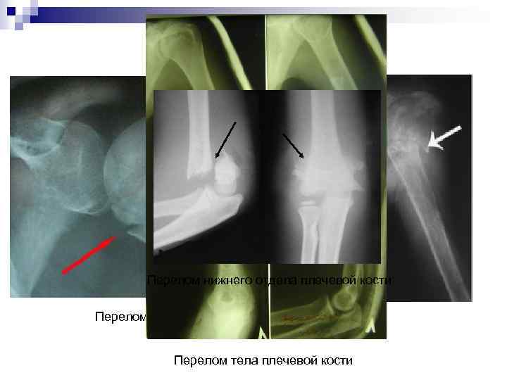 Перелом нижнего отдела плечевой кости Перелом верхнего отдела плечевой кости Перелом тела плечевой кости