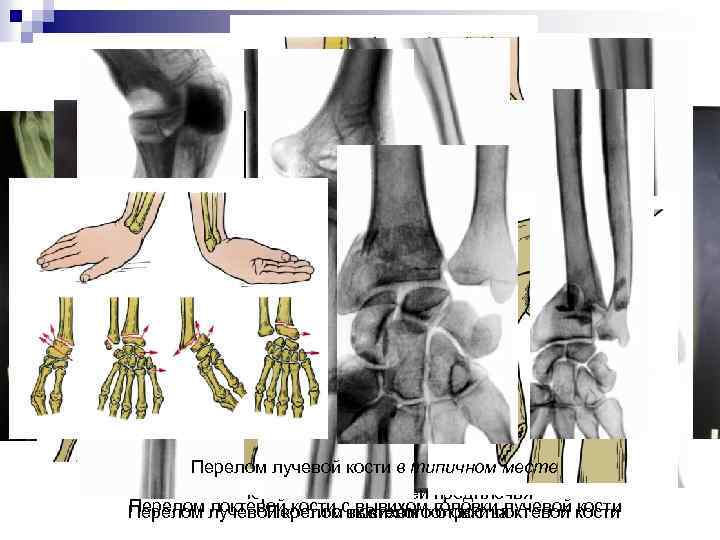 Перелом лучевой перелом локтевой месте Изолированный кости в типичном кости Изолированный перелом диафиза лучевой