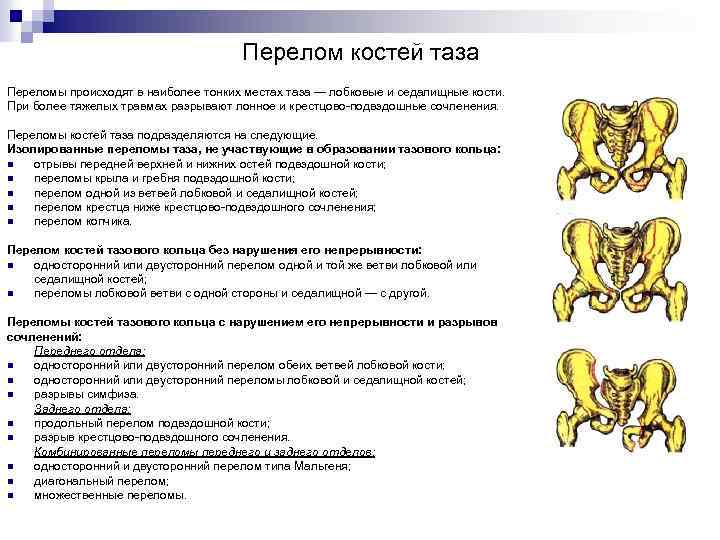 Перелом костей таза Переломы происходят в наиболее тонких местах таза — лобковые и седалищные