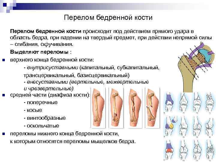 Перелом бедренной кости n n n Перелом бедренной кости происходит под действием прямого удара