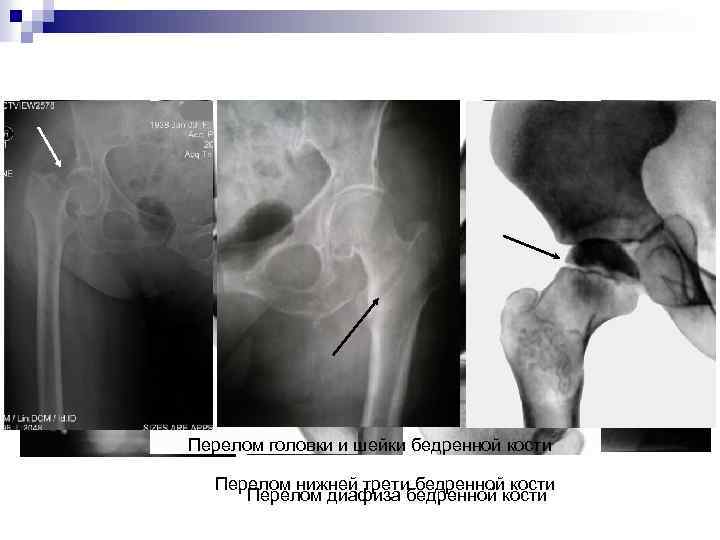 Перелом головки и шейки бедренной кости Перелом нижней трети бедренной кости Перелом диафиза бедренной