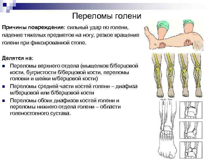 Переломы голени Причины повреждения: сильный удар по голени, падение тяжелых предметов на ногу, резкое