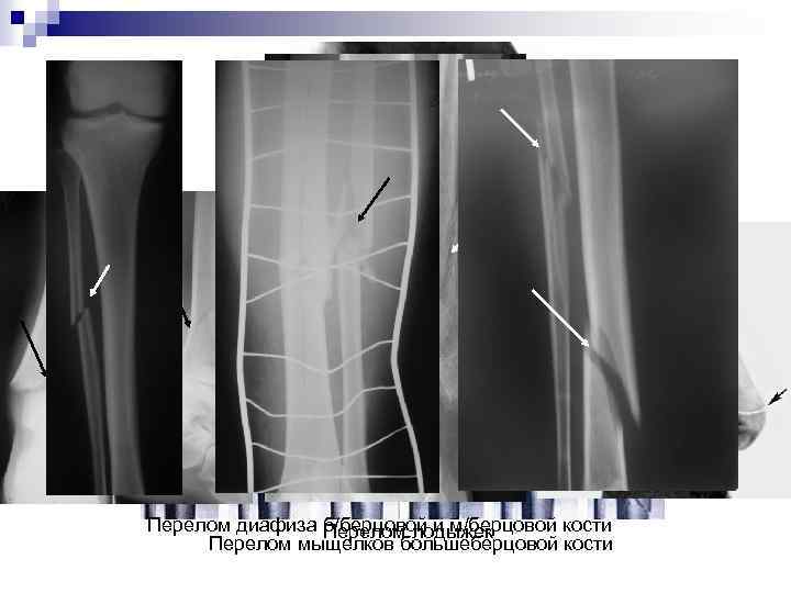 Перелом диафиза б/берцовой и м/берцовой кости Перелом лодыжек Перелом мыщелков большеберцовой кости 