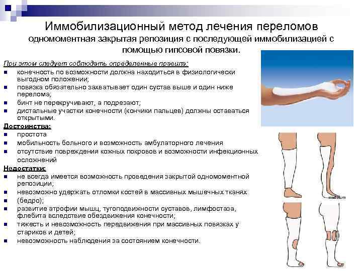 Иммобилизационный метод лечения переломов одномоментная закрытая репозиция с последующей иммобилизацией с помощью гипсовой повязки.