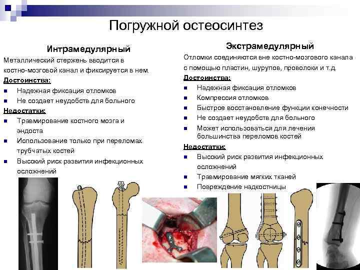Погружной остеосинтез Интрамедулярный Металлический стержень вводится в костно-мозговой канал и фиксируется в нем. Достоинства:
