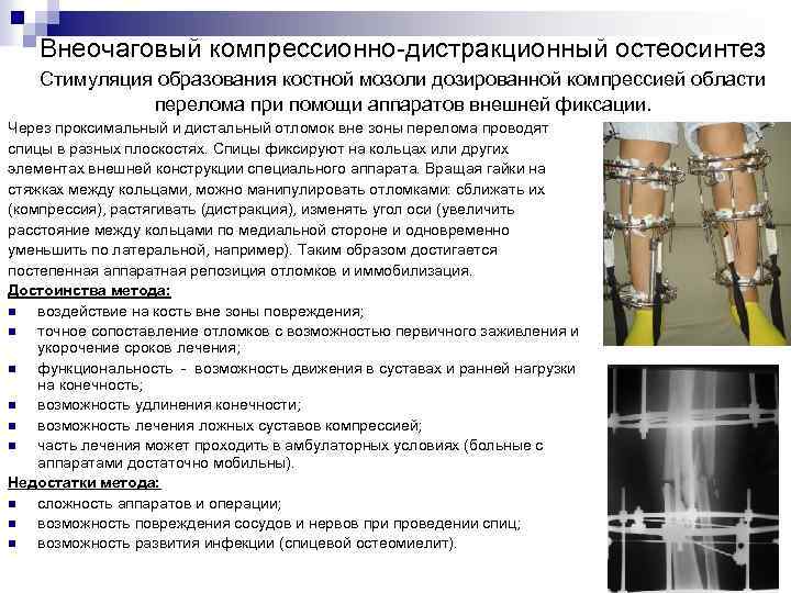 Внеочаговый компрессионно-дистракционный остеосинтез Стимуляция образования костной мозоли дозированной компрессией области перелома при помощи аппаратов