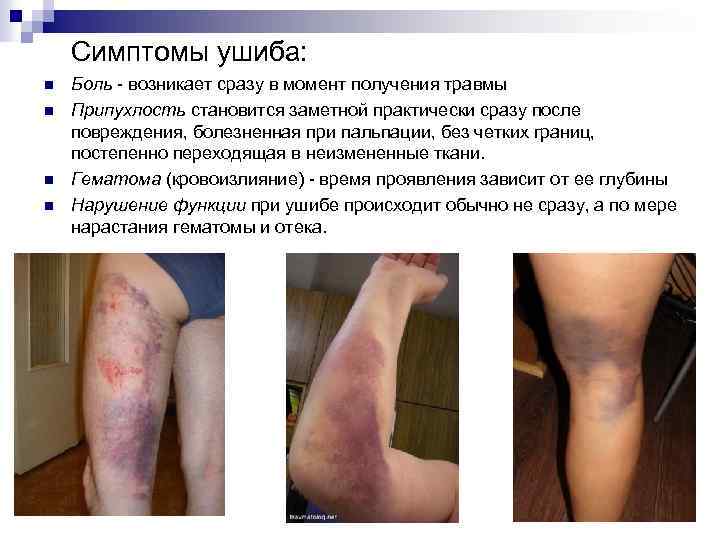 Симптомы ушиба: n n Боль - возникает сразу в момент получения травмы Припухлость становится