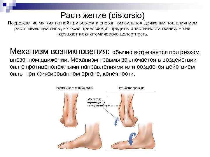 Растяжение (distorsio) Повреждение мягких тканей при резком и внезапном сильном движении под влиянием растягивающей