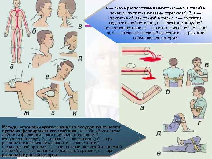 а — схема расположения магистральных артерий и точек их прижатия (указаны стрелками); б, в