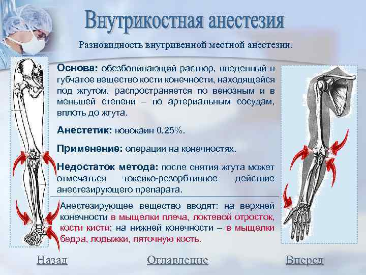 Разновидность внутривенной местной анестезии. Основа: обезболивающий раствор, введенный в губчатое вещество кости конечности, находящейся