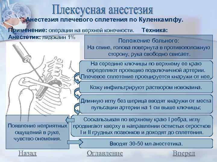 Анестезия плечевого сплетения по Куленкампфу. Применение: операции на верхней конечности. Техника: Анестетик: лидокаин 1%