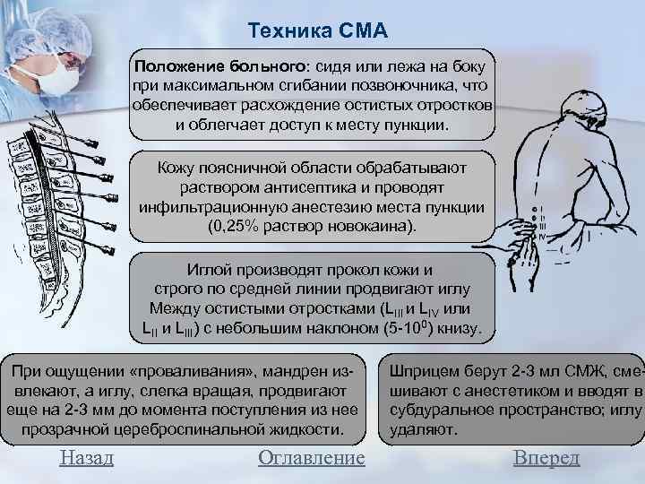 Техника СМА Положение больного: сидя или лежа на боку при максимальном сгибании позвоночника, что