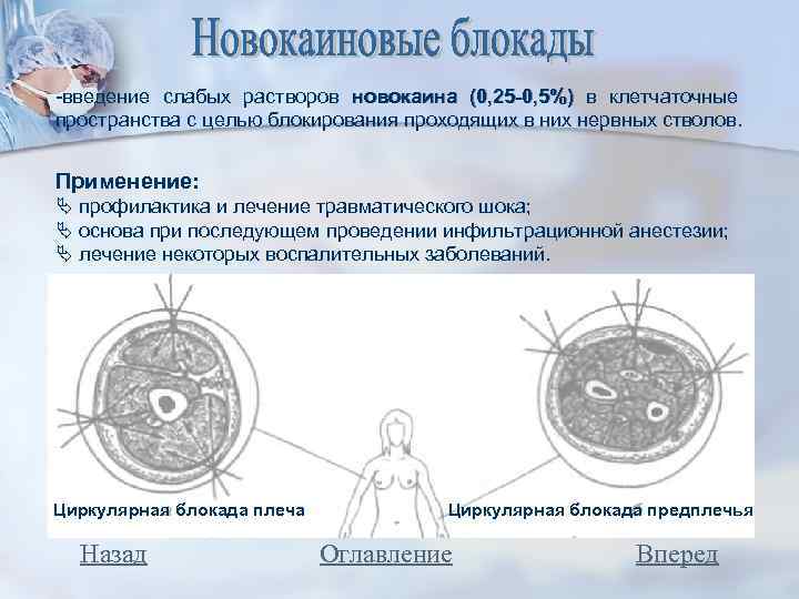 -введение слабых растворов новокаина (0, 25 -0, 5%) в клетчаточные пространства с целью блокирования