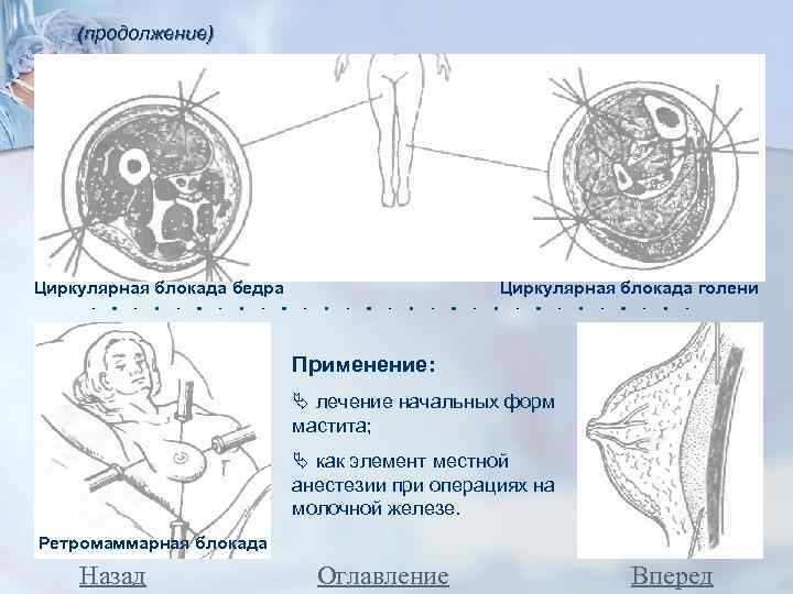 (продолжение) Циркулярная блокада бедра Циркулярная блокада голени Применение: лечение начальных форм мастита; как элемент