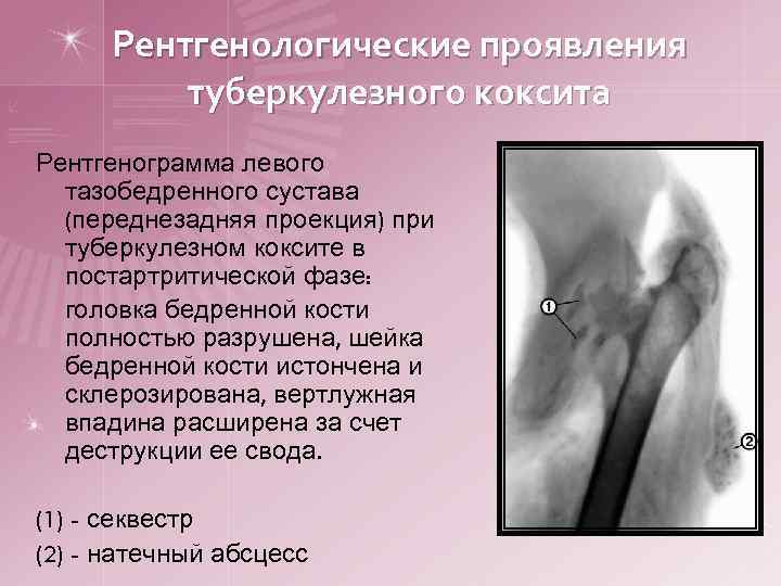 Рентгенологические проявления туберкулезного коксита Рентгенограмма левого тазобедренного сустава (переднезадняя проекция) при туберкулезном коксите в