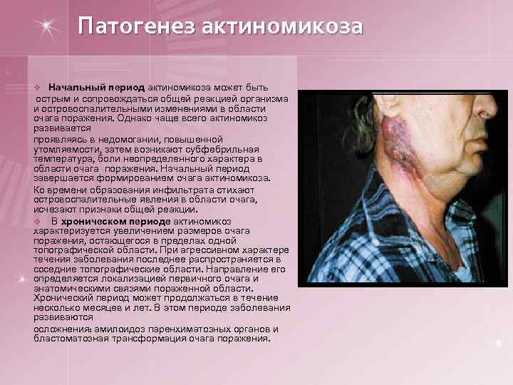 Патогенез актиномикоза v Начальный период актиномикоза может быть острым и сопровождаться общей реакцией организма