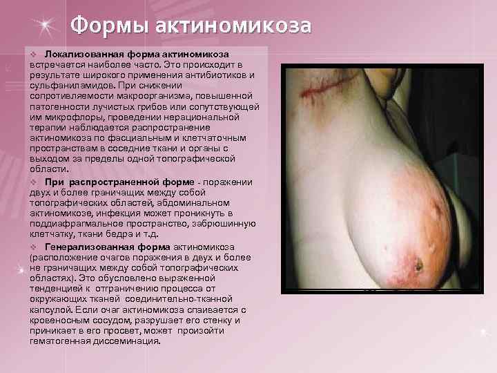 Формы актиномикоза v Локализованная форма актиномикоза встречается наиболее часто. Это происходит в результате широкого