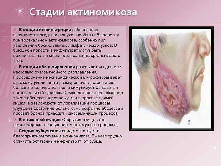 Стадии актиномикоза v В стадии инфильтрации заболевание оказывается сходным с опухолью. Это наблюдается при