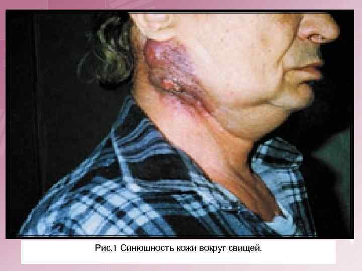 Рис. 1 Синюшность кожи вокруг свищей. 