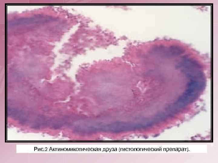 Рис. 2 Актиномикотическая друза (гистологический препарат). 