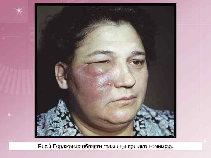 Рис. 3 Поражение области глазницы при актиномикозе. 