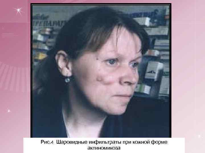 Рис. 4 Шаровидные инфильтраты при кожной форме актиномикоза 