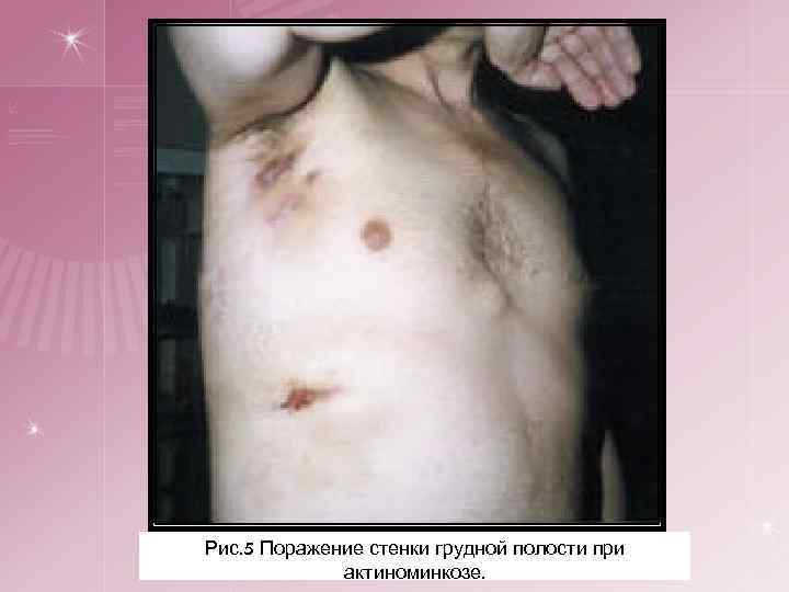 Рис. 5 Поражение стенки грудной полости при актиноминкозе. 