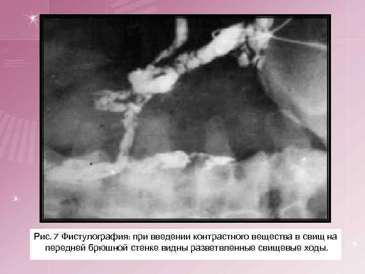 Рис. 7 Фистулография: при введении контрастного вещества в свищ на передней брюшной стенке видны