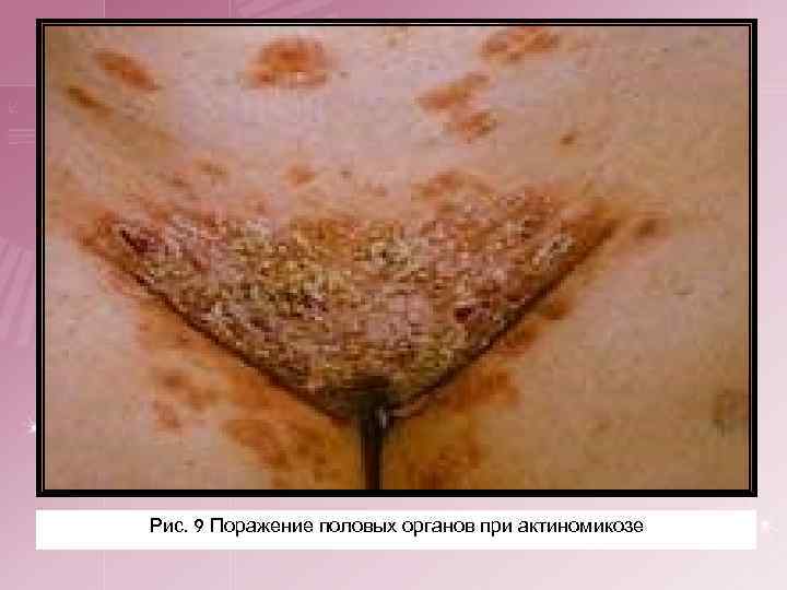 Рис. 9 Поражение половых органов при актиномикозе 