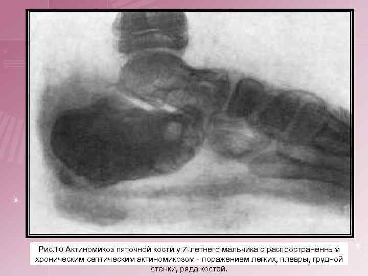 Рис. 10 Актиномикоз пяточной кости у 7 -летнего мальчика с распространенным хроническим септическим актиномикозом