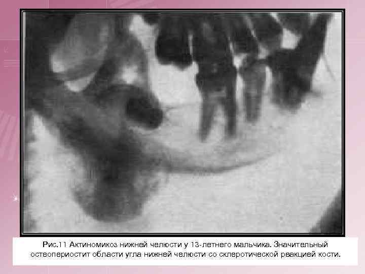 Рис. 11 Актиномикоз нижней челюсти у 13 -летнего мальчика. Значительный остеопериостит области угла нижней