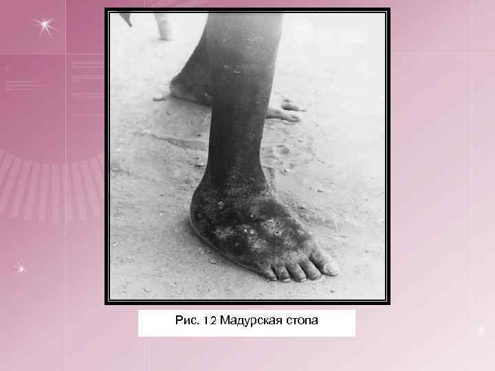 Рис. 12 Мадурская стопа 