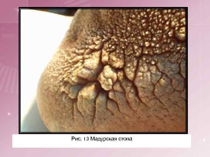 Рис. 13 Мадурская стопа 