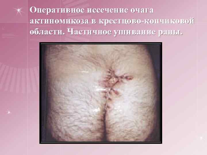 Оперативное иссечение очага актиномикоза в крестцово-копчиковой области. Частичное ушивание раны. 