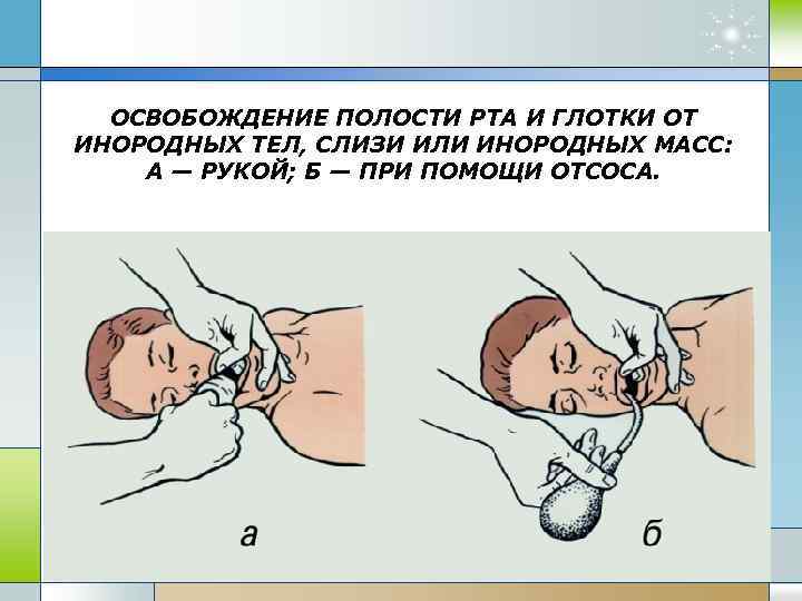 ОСВОБОЖДЕНИЕ ПОЛОСТИ РТА И ГЛОТКИ ОТ ИНОРОДНЫХ ТЕЛ, СЛИЗИ ИЛИ ИНОРОДНЫХ МАСС: А —