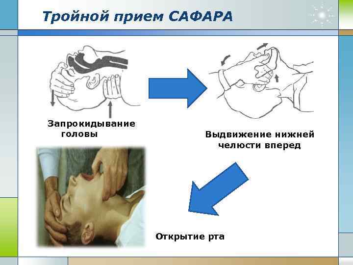 Тройной прием САФАРА Запрокидывание головы Выдвижение нижней челюсти вперед Открытие рта 