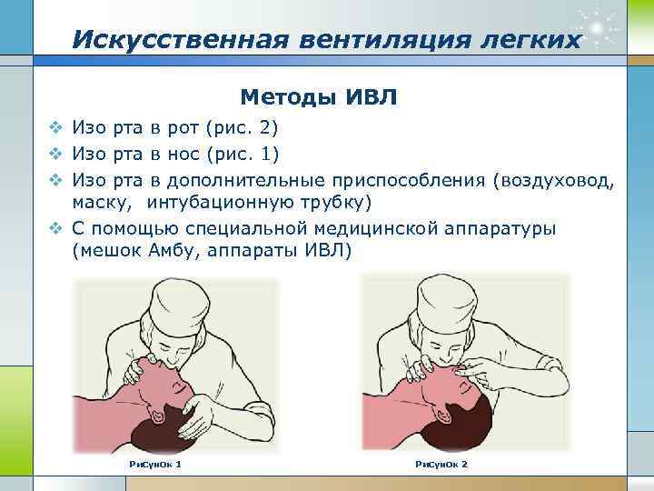 Искусственная вентиляция легких Методы ИВЛ v Изо рта в рот (рис. 2) v Изо