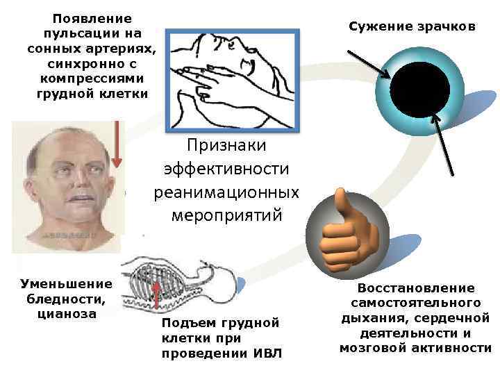 Появление пульсации на сонных артериях, синхронно с компрессиями грудной клетки 3 Уменьшение бледности, цианоза