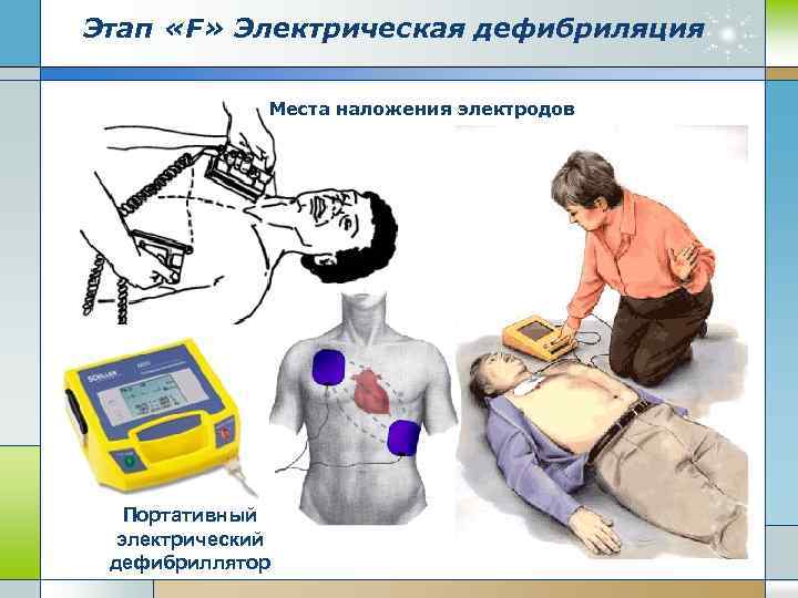 Этап «F» Электрическая дефибриляция Места наложения электродов Портативный электрический дефибриллятор 