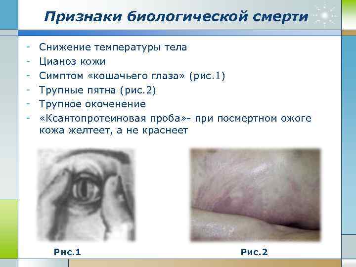 Признаки биологической смерти - Снижение температуры тела Цианоз кожи Симптом «кошачьего глаза» (рис. 1)